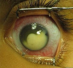 Первый симптом болезни покраснение глаза